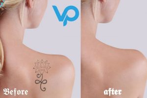 Tattoo Remove After & Before Asked Questions